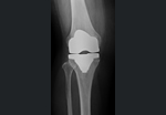 膝関節部品 | 術後X-P